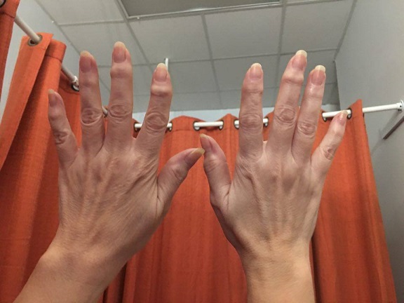 Before and after: Also available, skin tightening for mild case of ‘dishpan hands’  